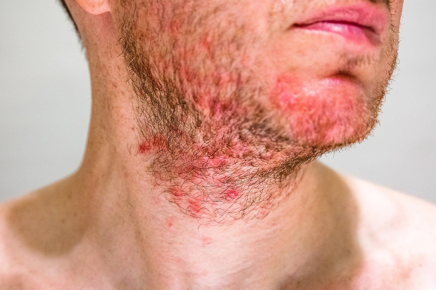 Beard Rash: A Four-Step Guide To Soothe and Prevent Future Breakouts